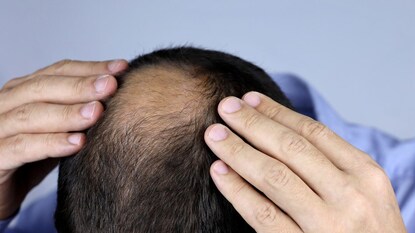 Hair Loss Hair Loss