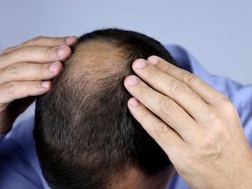 Hair Loss