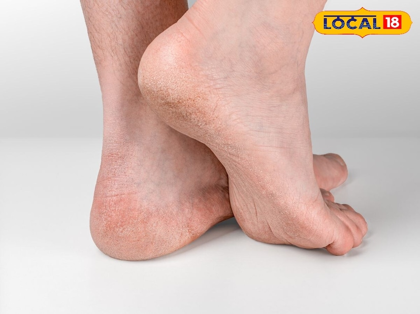 Disclaimer : या बातमीत दिलेली माहिती आणि आरोग्याशी संबंधित सल्ला तज्ञांशी झालेल्या संभाषणांवर आधारित आहे. ही सामान्य माहिती आहे, वैयक्तिक सल्ला नाही. म्हणून, डॉक्टरांचा सल्ला घेतल्यानंतरच काहीही वापरा. त्याच्या वापरामुळे होणाऱ्या कोणत्याही नुकसानासाठी लोकल-18 जबाबदार राहणार नाही. 