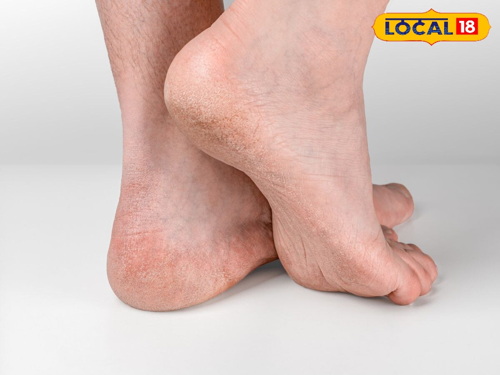 Health Tips : हिवाळ्यात तळपायाला भेगा पडतात? हा सोपा उपाय करून बघा, तळपाय राहील मुलायम