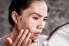 Hyperpigmentation : चेहऱ्यावरचे काळे डाग कमी कसे करायचे ? हे तीन उपाय वापरुन बघा