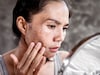 Hyperpigmentation : नैसर्गिक घरगुती उपायांची जादू, चेहऱ्यावरच्या डागांवर रामबाण