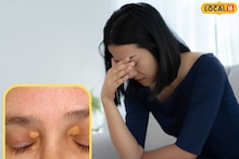 Health Tips : डोळ्यांवर पांढऱ्या खुणा दिसतायत? सावधान! तुमचं आरोग्य आहे धोक्यात, वेळीच घ्या काळजी