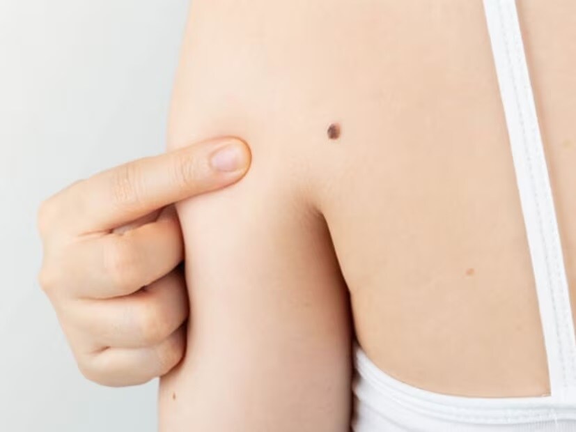 शरीरावरचा तीळ किंवा मस याचा आकार किंवा रंगात जर बदल झालेला दिसत असेल तर हे कॅन्सरचं सुरुवातीचं लक्षण असू शकतं. याशिवाय जखम न भरणं, त्वचेला खाज सुटणं हेदेखील कॅन्सरचं लक्षण असू शकतं.