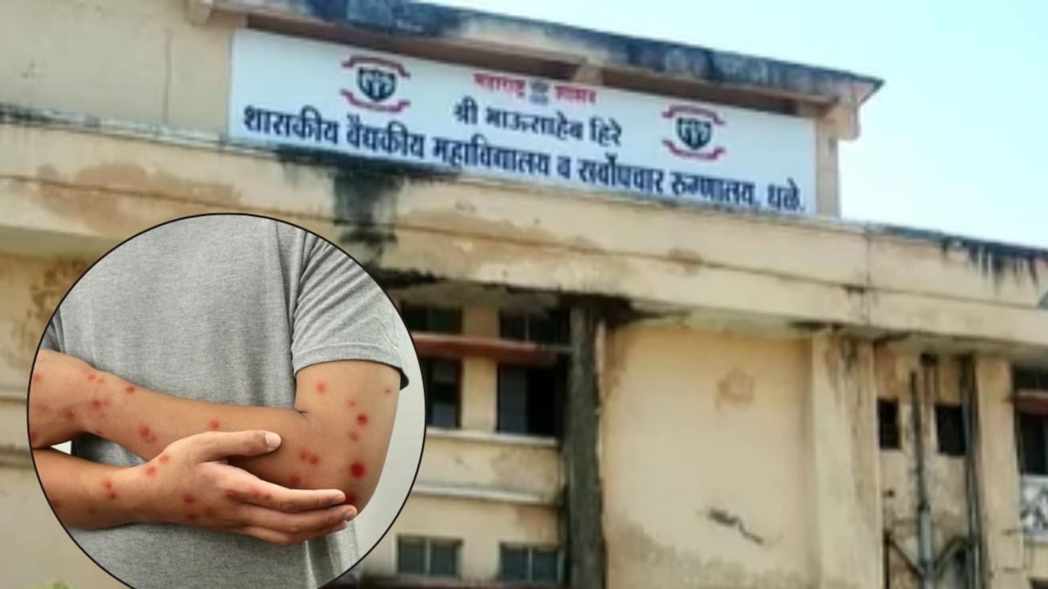 महाराष्ट्रात मंकी पॉक्सचा शिरकार, धुळ्यात आढळला पहिला रुग्ण, प्रशासन अलर्टवर महाराष्ट्रात मंकी पॉक्सचा शिरकार, धुळ्यात आढळला पहिला रुग्ण, प्रशासन अलर्टवर