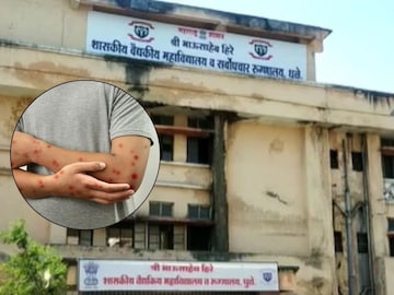 dhule news monkeypox patient