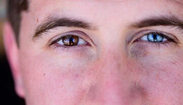 Eye Colours : डोळ्यांचा बदलतोय रंग, आरोग्यवर होऊ शकतो गंभीर परिणाम
