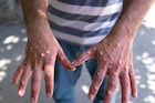 Monkeypox : 21 दिवसांनी दिसतात लक्षणं, अंगावर येतात पुरळ, संसर्गापासून कसं वाचाय