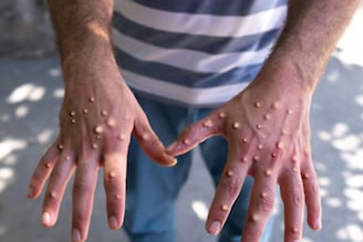 Monkeypox : 21 दिवसांनी दिसतात लक्षणं, अंगावर येतात पुरळ, संसर्गापासून कसं वाचाय