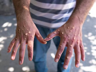 Monkeypox : 21 दिवसांनी दिसतात लक्षणं, अंगावर येतात पुरळ, संसर्गापासून कसं वाचाय