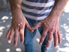 Monkeypox : 21 दिवसांनी दिसतात लक्षणं, अंगावर येतात पुरळ, संसर्गापासून कसं वाचाय