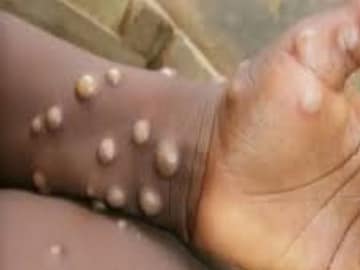 Monkeypox : 21 दिवसांनी दिसतात लक्षणं, अंगावर येतात पुरळ, संसर्गापासून कसं वाचाय Monkeypox : 21 दिवसांनी दिसतात लक्षणं, अंगावर येतात पुरळ, संसर्गापासून कसं वाचाय