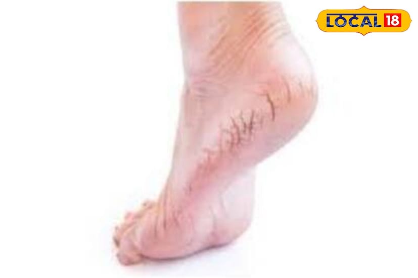 फुटलेल्या टाचांवर उपचार करण्यासाठी लिंबू आणि मधाचे मिश्रण अत्यंत प्रभावी मानले जाते. लिंबाचे नैसर्गिक ब्लीचिंग गुणधर्म त्वचा स्वच्छ करतात, तर मध मऊ करते आणि पोषण देते. दोन्ही मिसळा आणि ते 15-20 मिनिटे टाचांना लावा, नंतर धुवा. यामुळे मृत त्वचा सहजपणे निघून जाईल आणि टाचा चमकदार दिसतील. एका आठवड्यासाठी रोज याचा सराव करा आणि तुम्हाला परिणाम दिसतील.