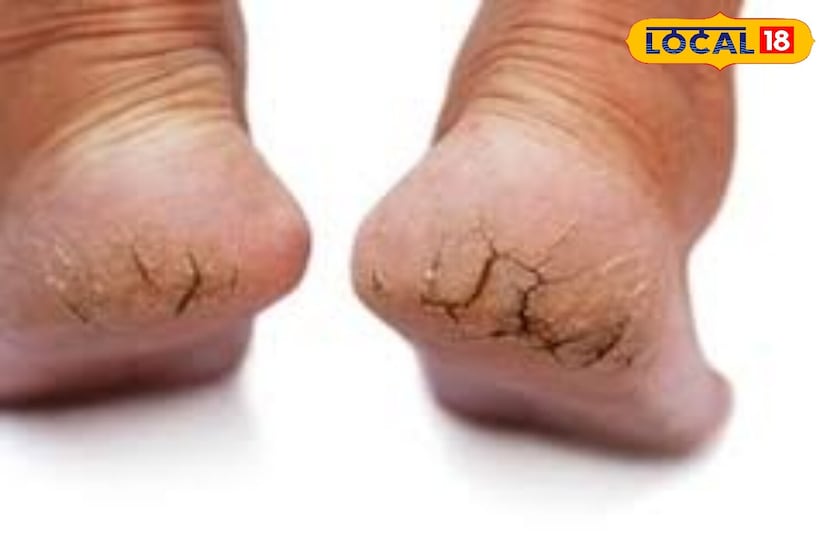 टाचांना बरे करण्यासाठी हलका मालिश करणे अत्यंत फायदेशीर मानले जाते. नियमित मालिश केल्याने भेगा भरून निघतातच, शिवाय ताण आणि निद्रानाश यासारख्या समस्याही दूर होतात. यासाठी मोहरी, नारळ किंवा बदाम तेलाचा वापर करता येतो. फक्त ते तेल तुमच्या पायांना लावा आणि झोपण्यापूर्वी काही मिनिटे मालिश करा. सतत हा उपाय केल्याने टाचा मऊ होतील आणि वेदना कमी होतील.