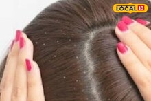 Health Tips : हिवाळ्यात केसांमध्ये होतोय कोंडा? हे उपाय लगेच करा, राहाल गंभीर आजारांपासून दूर