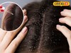 हिवाळ्यात केसांत कोंडा वाढतोय, खाजही सुटते? डॉक्टरांनी सांगितला रामबाण उपाय