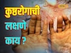 कुष्ठरोग दैवी शाप नाही, ही लक्षणे असतील तर त्वरीत डॉक्टरांना दाखवा, Video