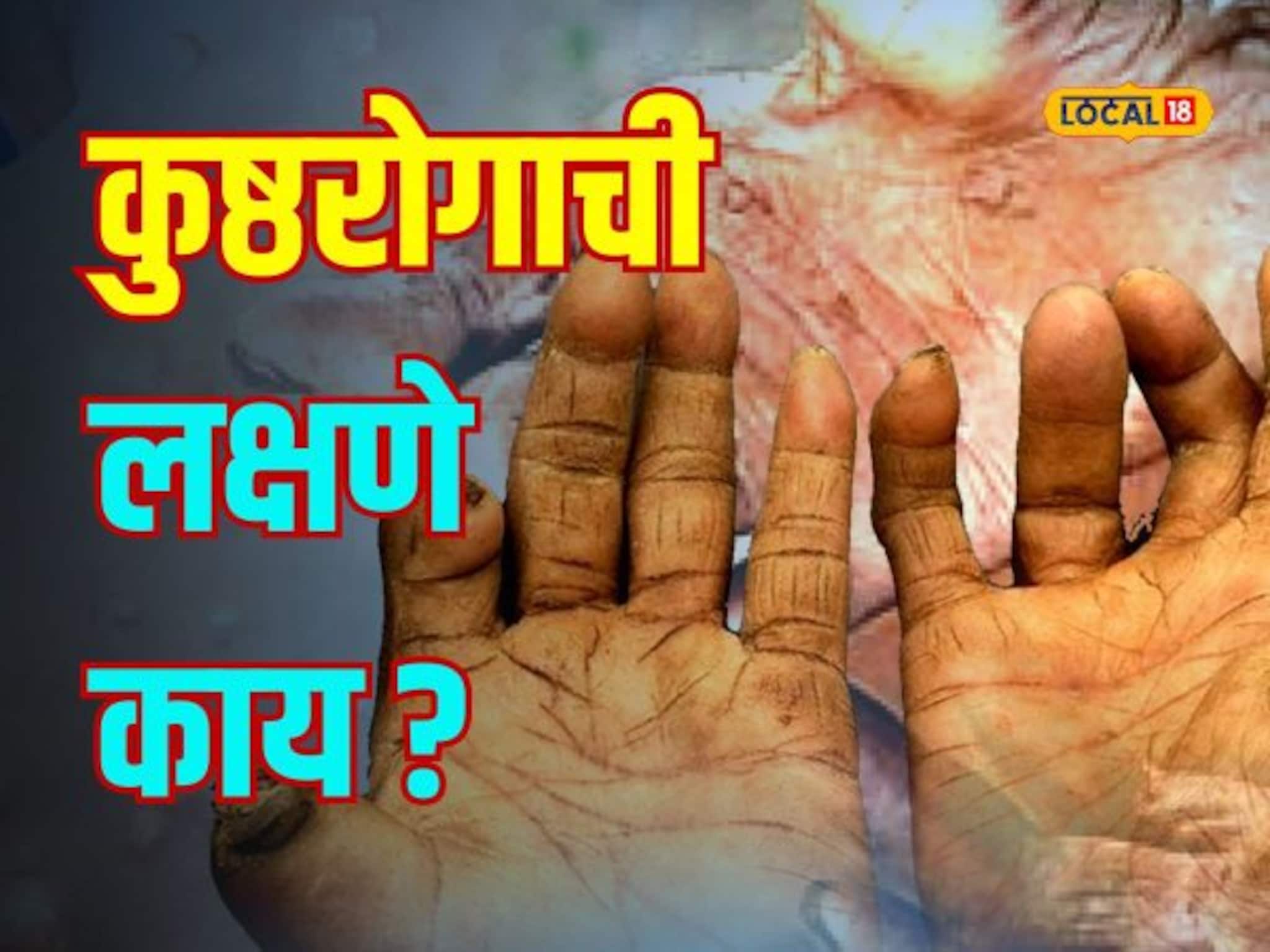 कुष्ठरोग दैवी शाप नाही, ही लक्षणे असतील तर त्वरीत डॉक्टरांना दाखवा, Video