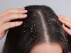 Dandruff : केसांतला कोंडा कमी करण्यासाठी हे उपाय वापरुन पाहा, केस दिसतील सुंदर