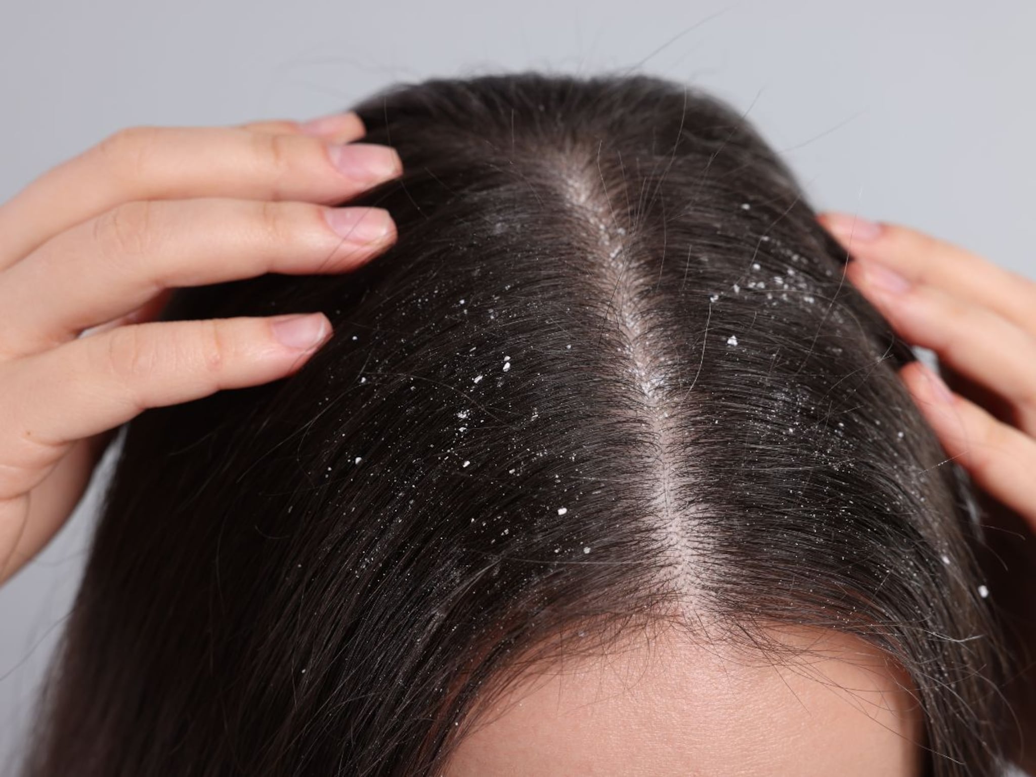 Dandruff : कोंडा गायब करण्यासाठी घरगुती उपाय, केसांचं आरोग्य राहिल उत्तम