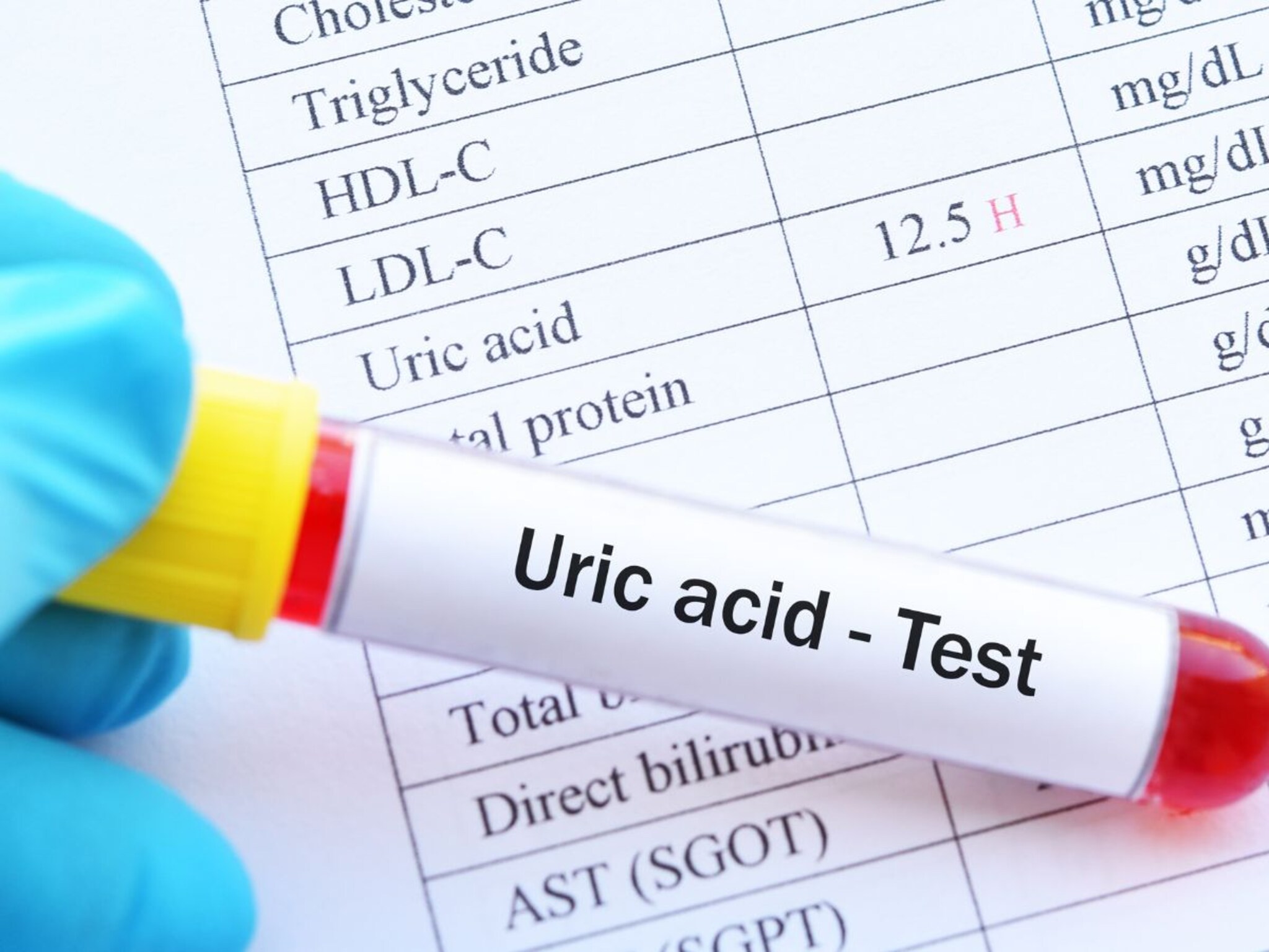 Uric Acid : युरिक अ‍ॅसिडची पातळी नियंत्रणात आणण्यासाठी हे उपाय लक्षात ठेवा, प्रकृती राहिल चांगली