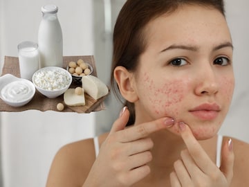 त्वचेवरील जळजळ टाळण्यासाठी हे खाणं सोडा..  