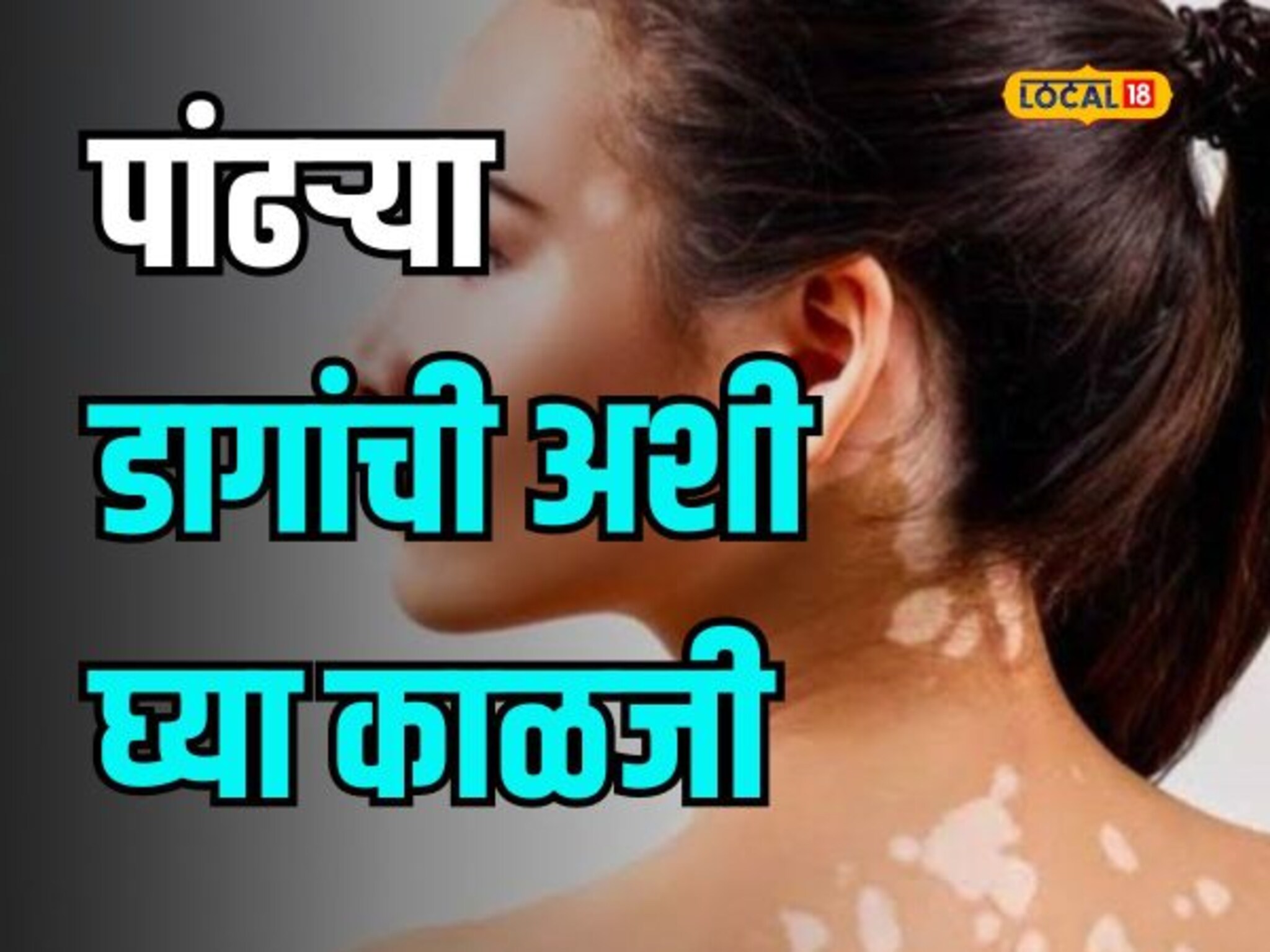 Health Tips : शरीरावर पांढरे डाग आहेत? घाबरुन जाऊ नका; अशी घ्या काळजी