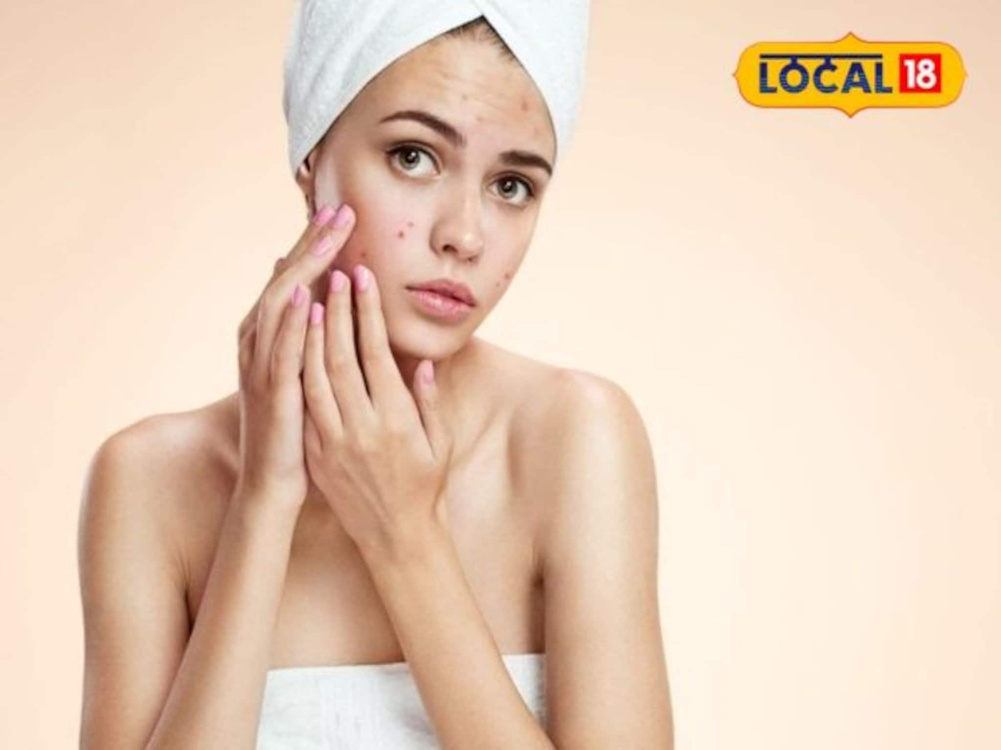 चेहऱ्यावर पिंपल्स आले असतील तर चुकूनही करू नका या तीन गोष्टी, नाहीतर होईल मोठे नुकसान