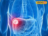 यकृताचा कर्करोग खूप भयंकर! लक्षणं दिसताच डॉक्टरांकडे जा, पोट फुगल्यासारखं वाटलं तर...