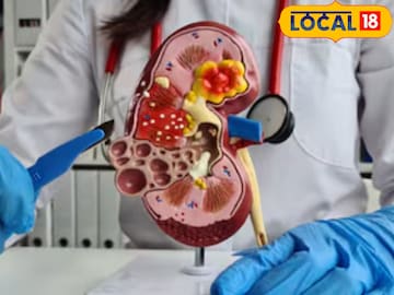 आजीने दिली किडनी आजीने दिली किडनी