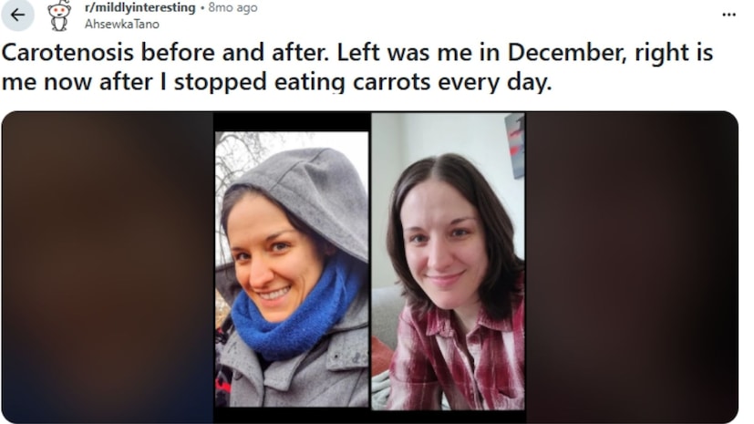 रेडिटच्या माइल्डली इंटरेस्टिंग फोरमवरही यासंबंधीच्या एका प्रकरणाची चर्चा झाली. एका महिलेने तिच्या त्वचेतील बदलांचे आधी आणि नंतरचे फोटो शेअर केले, ज्यामध्ये तिने गाजर खाण्याआधी आपला चेहरा लाल आणि नंतर सामान्य दिसत असल्याचं दाखवलं.