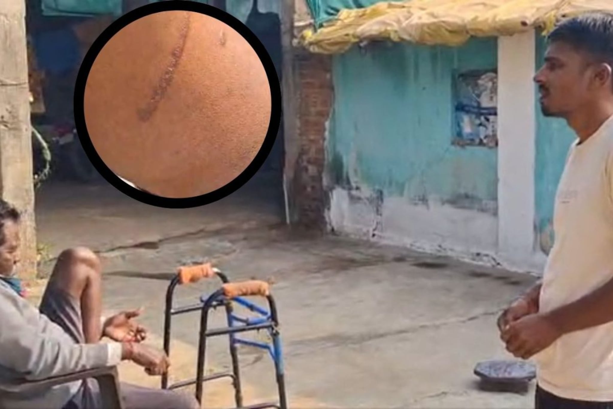 चंद्रपुरातील शेतकऱ्याने कर्जापायी किडनी विकली चंद्रपुरातील शेतकऱ्याने कर्जापायी किडनी विकली