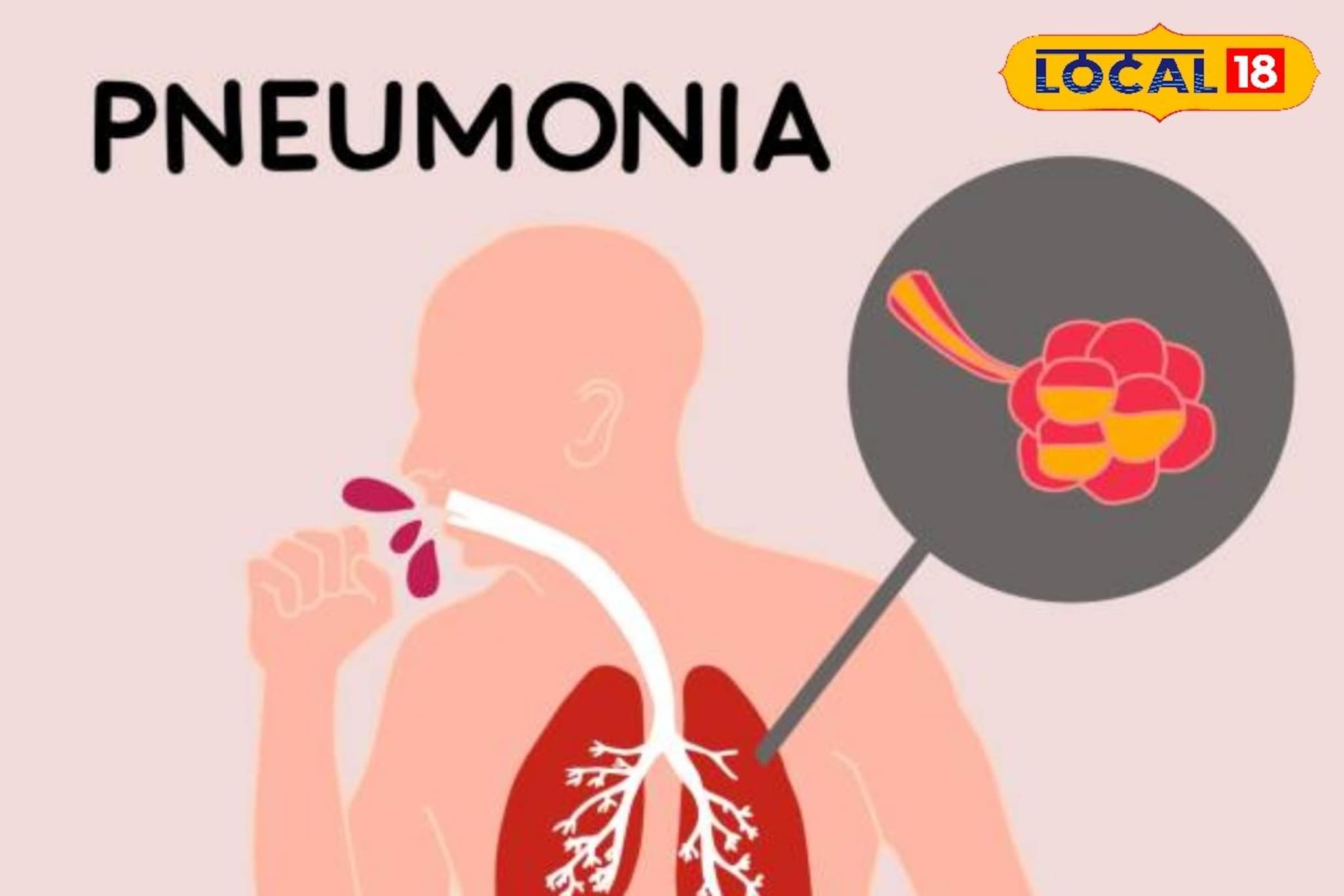 7- 8 दिवस खोकला राहतो, ताप येतो, पुण्यात नव्या आजाराचं थैमान, डॅाक्टरांचा अलर्ट 7- 8 दिवस खोकला राहतो, ताप येतो, पुण्यात नव्या आजाराचं थैमान, डॅाक्टरांचा अलर्ट