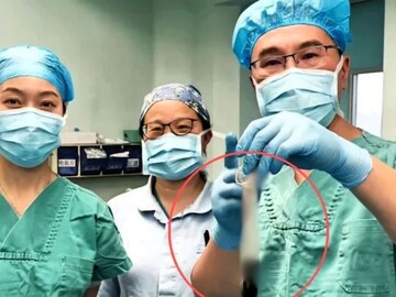 नशेत गिळला लायटर, 30 वर्षे पोटातच; डॉक्टरांनी कंडोम वापरून काढला, कसा काय?