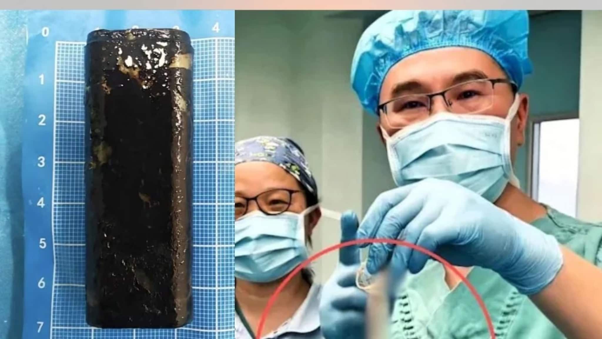 नशेत गिळला लायटर, 30 वर्षे पोटातच; डॉक्टरांनी कंडोम वापरून काढला, कसा काय?