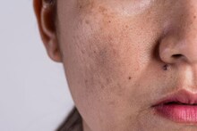 Skin Problem : तुमच्या चेहऱ्यावरील वांग फक्त त्वचेची समस्या नाही; डॉक्टर म्हणाले, 'हा' अवयव खराब होण्याची सुरुवात