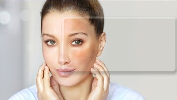 वांग फक्त त्वचेची समस्या नाही; डॉक्टर म्हणाले, 'हा' अवयव खराब होण्याची सुरुवात