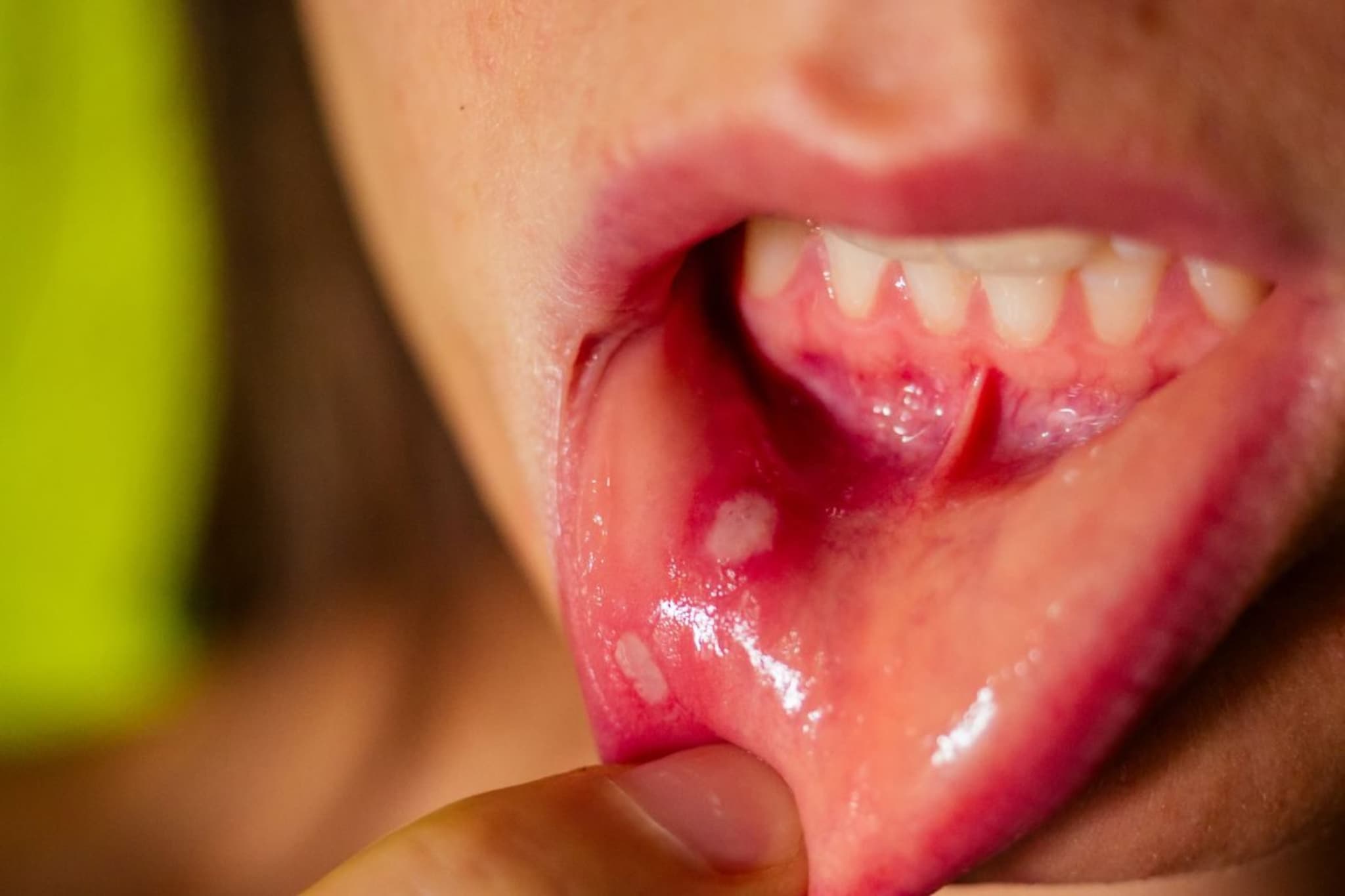 Mouth Ulcers : तोंडातल्या अल्सरवर घरगुती उपचार, वेदना होतील कमी, फोड होतील गायब