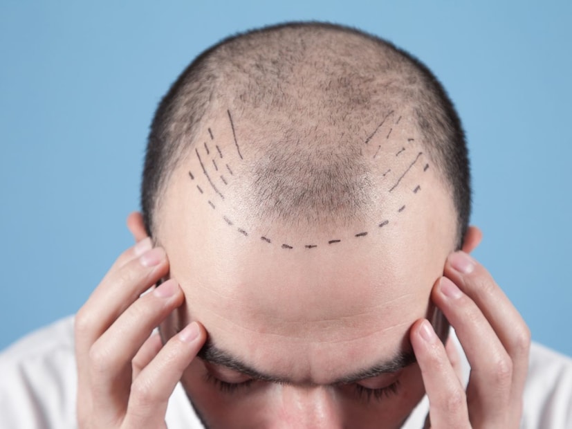 अयोग्य आणि निकृष्ट हेअर ट्रान्सप्लांटमुळे डोक्याच्या त्वचेवर गंभीर संसर्ग होण्याचा धोका वाढतो. संदीप नावाच्या एका व्यक्तीने हेअर ट्रान्सप्लांट करून घेतल्यानंतर त्याला सुरुवातीला डोकेदुखी आणि खाज सुरू झाली. काही दिवसांतच ही समस्या वाढली आणि त्याच्या डोक्यात संसर्ग, पुरळ आणि पस भरला. या असह्य वेदनांमुळे त्याला रात्रंदिवस डोकेदुखीचा त्रास सहन करावा लागला. अशा गंभीर संसर्गावर वेळीच उपचार न केल्यास त्वचेचे कायमस्वरूपी नुकसान होऊ शकते.