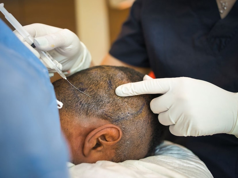 हेअर ट्रान्सप्लांटचा मूळ उद्देश डोक्यावर पुन्हा केस वाढवणे हा असतो. मात्र, काही प्रकरणांमध्ये या उपचाराचा मूळ उद्देशच सफल होत नाही. एका युवकाने दोन वर्षांपूर्वी फ्रंट लाइन हेअर ट्रान्सप्लांट करून घेतले होते आणि त्यासाठी त्याने मोठी रक्कमही मोजली होती. सेंटरच्या संचालकांनी त्याला केस वाढतील असे आश्वासन दिले होते, परंतु शस्त्रक्रियेनंतर त्याच्या केसांची वाढ पूर्णपणे थांबली. यामुळे त्याचा पैसा वाया गेलाच. सोबत केस परत मिळवण्याची आशाही फोल संपली.  