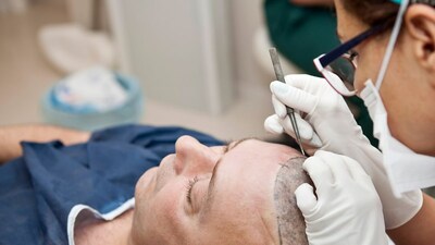 हेअर ट्रान्सप्लांट ट्रीटमेंटमुळे झालेल्या गंभीर समस्येची काही उदाहरणं आज आम्ही तुम्हाला सांगत आहोत. एका पोलीस निरीक्षकाने एका अनधिकृत केंद्रातून हेअर ट्रान्सप्लांट करून घेतले. या शस्त्रक्रियेनंतर त्यांच्या चेहऱ्याला पॅरालिसिस झाला आणि त्यांना बोलण्यात अडचण येऊ लागली. 