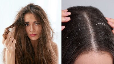 Homemade Winter Hair Masks: Soften Dry Hair, Fight Dandruff