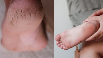 Shahnaz Husain's Easy Home Remedy for Winter Cracked Heels