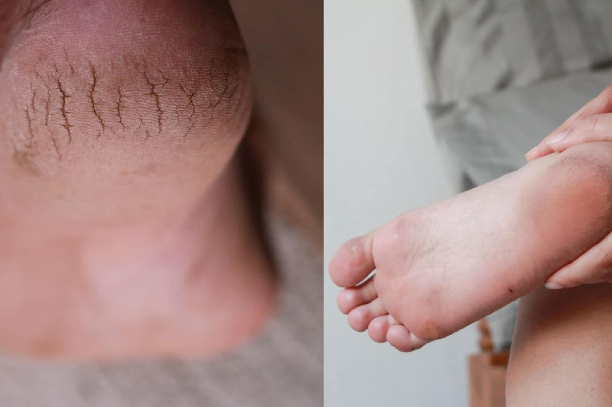 Winter Care : भेगाळलेल्या टाचांवर रामबाण उपाय, या इलाजानं टाचा होतील मऊ