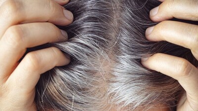 Why Hair Grays Early? Dermatologist Reveals Key Reasons & Remedies