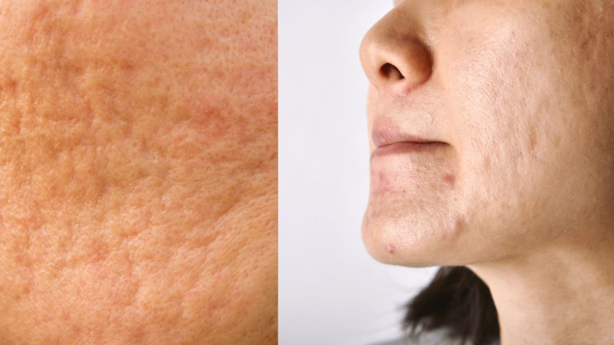 Skin Care : चेहऱ्यावरच्या खड्ड्यांना औषध काय ? मुरुमांमुळे झालेले डाग कमी करण्यासाठी उपचार