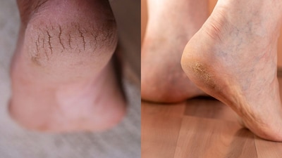 फटी एड़ियों के लिए आसान घरेलू उपाय: सर्दियों में पाएं राहत.