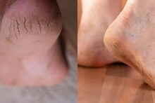 Cracked heels : भेगाळलेल्या टाचांसाठी सोपे घरगुती उपाय, या विंटर केअर टिप्स वापरुन पाहा