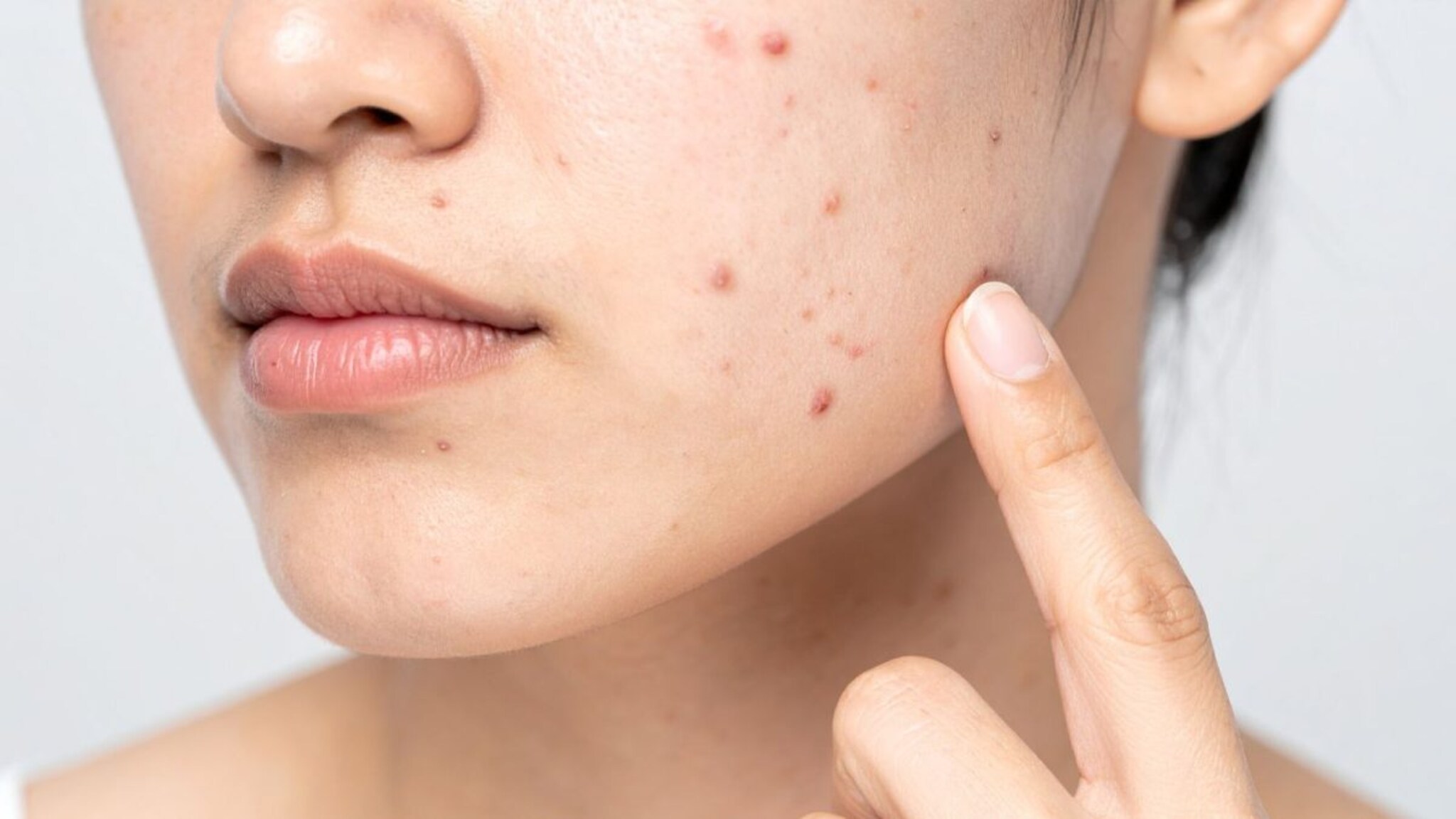 Pimples : चेहऱ्यावर मुरुम येण्यामागची कारणं शोधा, मगच उपचार करा, त्वचारोगतज्ज्ञांचा सल्ला नक्की वाचा