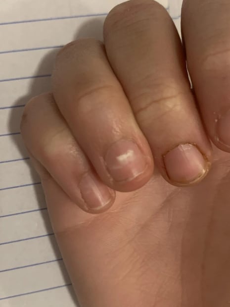 अनामिकेवरील शुभ्र निशाण: अनामिकेच्या नखावर पांढरा बिंदू दिसणे सामाजिक सन्मान वाढवतो. यामुळे तुम्हाला समाजात ओळख मिळते आणि सरकारी क्षेत्रात किंवा उच्च पदावर यश प्राप्त होते.